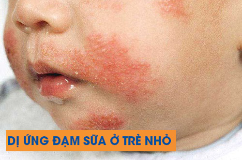 Trẻ bị dị ứng đạm sữa bò nên dùng sữa nào thay thế?